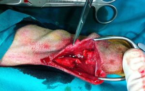 Imagen de rotura del tendón del calcáneo operada con epidural Imagen de rotura del tendón del calcáneo operada con epidural