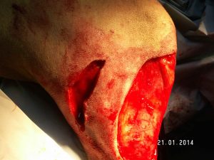 Incisión de descarga junto a una herida quirúrgica amplia tras extirpar un tumor Incisión de descarga junto a una herida quirúrgica amplia tras extirpar un tumor