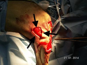 El cierre de la escisión del tumor se completa en linea aunque el cierre de la linea de descarga lateral se cierra en su mitad superior mediante una plastia en Y El cierre de la escisión del tumor se completa en linea aunque el cierre de la linea de descarga lateral se cierra en su mitad superior mediante una plastia en Y