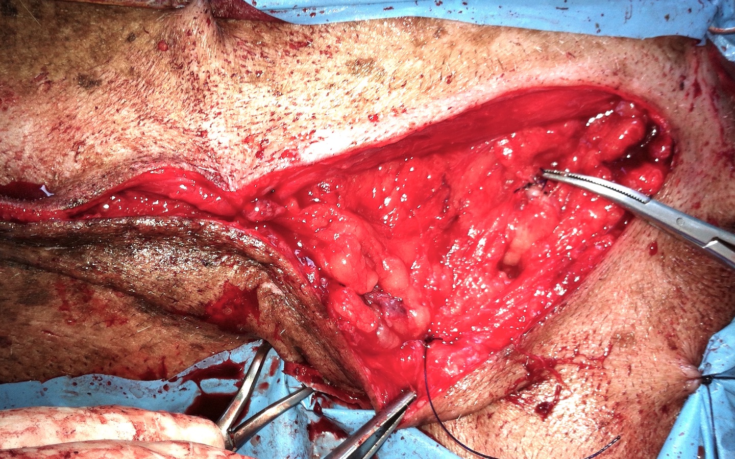 En esta zona sobre el anillo inguinal y en medial al muslo el cierre debe ser mas estanco.